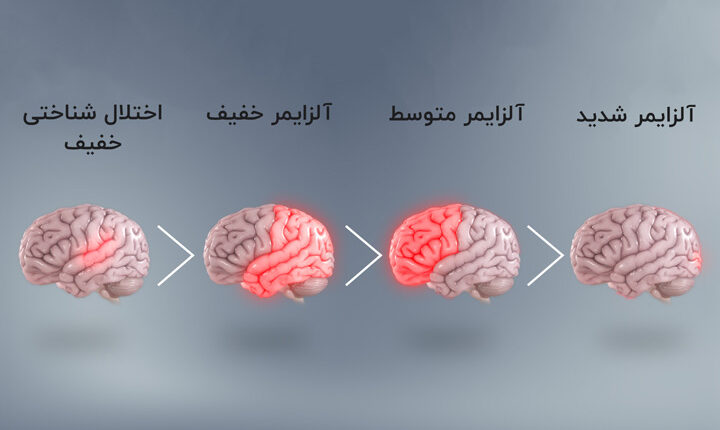 مراحل بیماری آلزایمر چیست - مراحل کلی آلزایمر