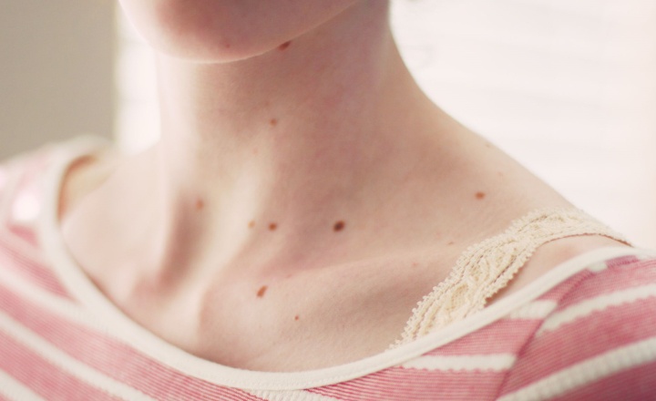 تغییرات ناگهانی در پوست می تواند نشانه سرطان باشد