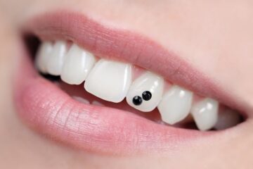طراحی لبخند با کاشت نگین دندانی چگونه است؟
